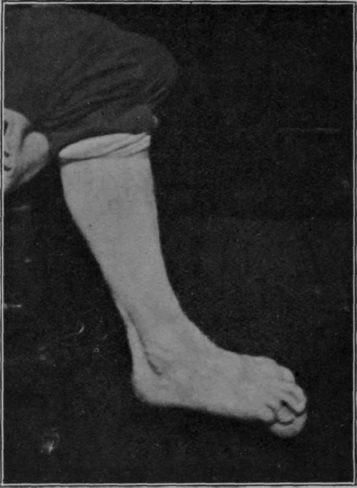 Fig. 155.   The patient has picked up a golf ball with his toes