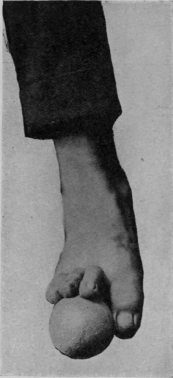 Fig. 157.   A second view showing the grip required when picking up a tennis ball with the toes