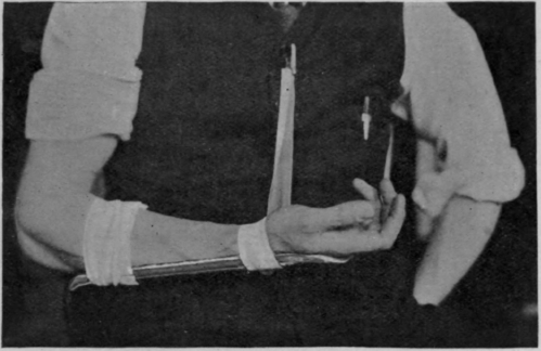 Fig. 158.   To show how a forearm may be slung in supination while a short metal splint is still worn