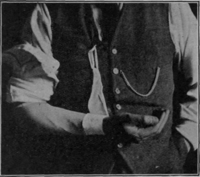 Fig. 159. To show how a forearm may be slung in supination without the use of a splint