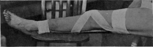 Fig. 160. To show the application of a straight posterior splint to the back of the leg so as to avoid undue pressure on the vastus internus