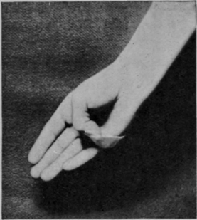 Fig. 162.   To show how the opponens pollicis can be prevented from stretching by the application of adhesive plaster. If desired the nail need not be covered, as the plaster can be split and made to encircle the distal phalanx