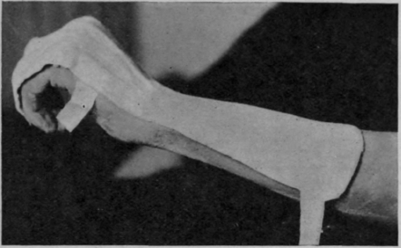 Fig. 163.   A posterior plaster splint which inhibits over action of all the extensors while allowing perfect freedom of action to the flexors of the fingers