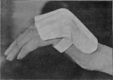 Fig. 164.   A posterior plaster splint which only inhibits over action of the extensors of the metacarpo phalangeal joints. There is a tendency for this splint to rest the interossei as well. In practice, when these muscles are paralysed, the interphalangeal joints remain extended when the proximal joints are flexed and the long flexors are also at rest. The latter are, of course, free to act; but, on relaxing, the fingers tend to straighten when this splint is applied. If, on the other hand, the interossei are paralysed and the metacarpo phalangeal joints are free to extend, flexion deformity at the interphalangeal joints is inevitable