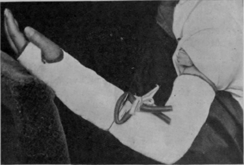 Fig. 166.   Capt. Verrall's supinating (or pronating) plaster of Paris splint
