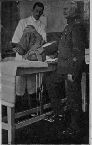 Fig. 167. The table and apparatus in use at the Special Surgical Hospital for stretching thigh amputation cases with flexion deformity