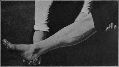 Fig. 2. The same as in Fig. I, the limb being supported only at the heel. The long axis of the oval becomes vertical