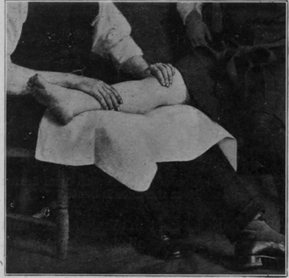 Fig. 32.   To show most useful position for mobilisation of the knee. Note the play of the masseur's feet when comparing these figures and Nos. 33 and 34
