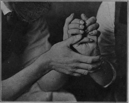 Fig. 38.   First position in performing flexion of a single finger. The metacarpo phalangeal joint is fully flexed. Note the extension of the wrist. Either the index finger or the thumb may be used to perform the movement. (For further details of technique, see Chap. XVII.)