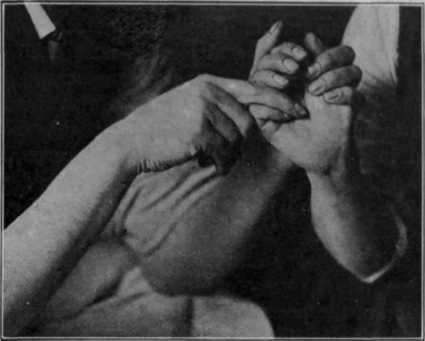 Fig. 39.   Second position in performing flexion of the fingers. The proximal interphalangeal joint is fully flexed, the metacarpo phalangeal has been slightly extended