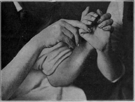 Fig. 40.   Third position in performing flexion of the fingers. The distal interphalangeal joint is fully flexed as well as the proximal. To effect this the metacarpo phalangeal joint has been fully extended