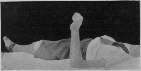 Fig. 42. To show the same position as in Fig. 41, free movement having been performed from almost full supination to full pronation