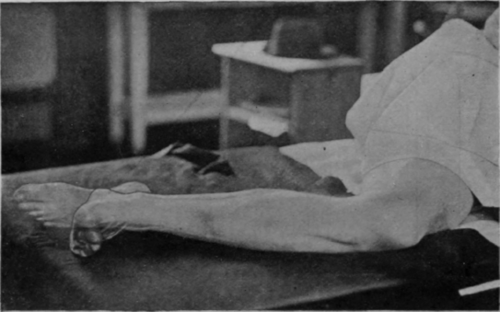 Fig. 47. To show the position for free movement of the ankle. Movement of the toes in this position is also free.