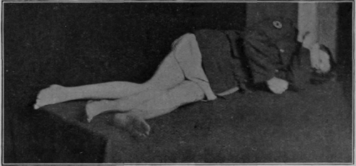 Fig. 48. To show the position for free movement of the knee. If the patient's left thigh were drawn back, the knee well flexed, and if the right thigh were drawn forward, extension of the right knee would be assisted by gravity