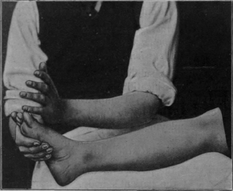 Fig. 5.   Showing upward surface stroking of the lower extremity. In practice, in order to secure the fullest effect, the stroke should be continued up the thigh. Note that the stroke commences before the hand comes in contact with the limb, and also the slight flexion of the knee