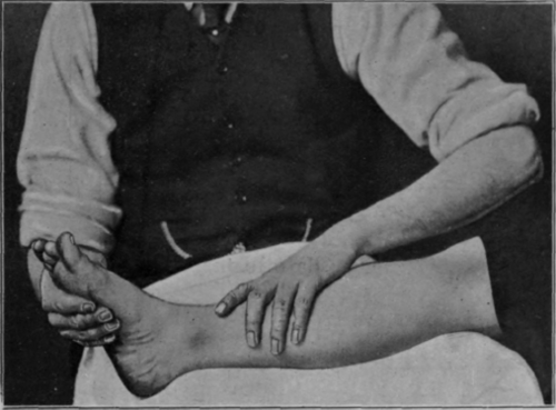 Fig. 6.   Showing upward surface stroking of the lower extremity, the middle of the stroke. Note how the hand is adapting itself to the contour of the limb. There is no fear of the patient noticing any scratching or tickling sensation