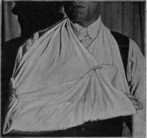 Fig. 63. Correct position for carrying the forearm in a sling