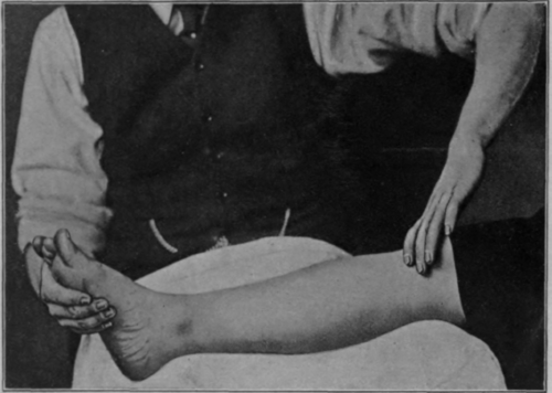 Fig. 7.   Showing upward surface stroking of the lower extremity, the finish of the stroke just before contact between hand and skin ceases. Although reference is made to the commencement and the finish of the stroke, it must be clearly understood that the finish represents equally well the commencement of the return of the hand through the air. As the movement is continuous, there can be no beginning or end.