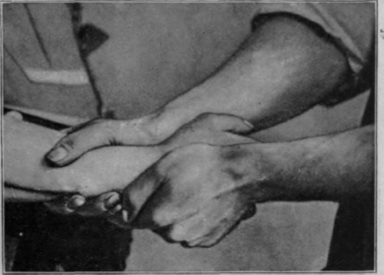 Fig. 80.   To show the method of reducing a Colles' fracture practised by Sir Robert Jones. By this means it is often possible to reduce deformity a very considerable time after fracture has taken place. No further damage is done to the already seriously injured tendons, tendon sheaths and ligaments