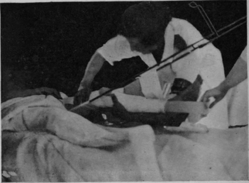 Fig. 83. To show the administration of a dose of relaxed movement to the knee joint of a patient with fractured femur, before union is firm enough to allow removal of the extension. It was in this manner that treatment was given to the patient shown in Figs. 86 and 87 on and after the tenth day from the receipt of a septic G.S.W. of middle third of the shaft of the femur. The ordinary surgical treatment of the wound, drainage, irrigation, subsequent sequestrotomy, etc., was carried out concurrently