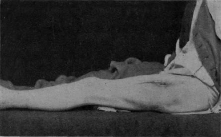 Fig. 84. This and the subsequent photo were taken of a patient before discharge from the Special Surgical Hospital, Shepherd's Bush. He sustained the ordinary septic G.S.W. of femur on August 24th, 1918. He was treated on a Thomas' knee splint. Massage and relaxed movements were begun on September 21st. Flexion through 55° was secured by the middle of October. A month later he was taken off individual treatment and placed in a special class for exercise without weight, and by the 25th November his knee could be bent to a right angle. The muscular development and power is shown in Fig. 85