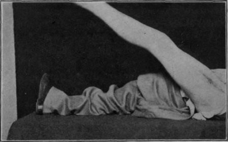 Fig. 85. Same patient as that shown in Fig. 84. Note the power of full extension of the knee and general good condition. Photo taken (about) March 3rd, 1919. There was no visible deformity or shortening