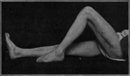 Fig. 86. The second of seven cases who were taken off individual massage treatment, and treated thenceforth in a special class for exercise within three months of sustaining septic gunshot wounds of the femur. History