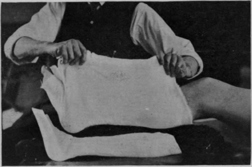 Fig. 89   To show how a leg may be raised from a posterior gutter splint by means of a cradle of lint before union is consolidated