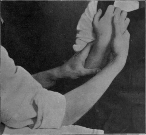 Fig. 94 To show the second position when trying to secure the last few degrees of supination