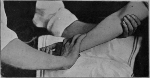Fig. 95. To show the final position when trying to secure the last few degrees of supination. The passage from the position shown in Fig. 94 to that here depicted should be rapid