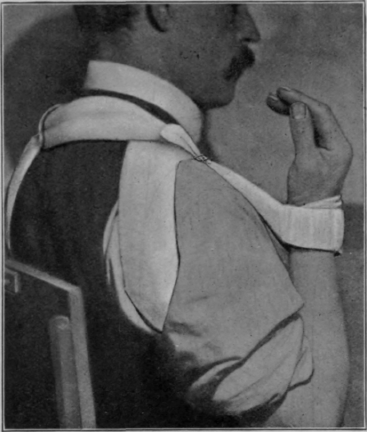 Fig. 97. To show flexion of elbow being secured by use of the cuff and collar. This shows how the elbow can be fully flexed and supination secured