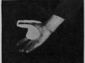 Front view. Fig. 165. To show the application of a thumb abduction splint. Note that the splint is applied with the first metarcarpal in opposition. The distal phalanx of the thumb is usually left free