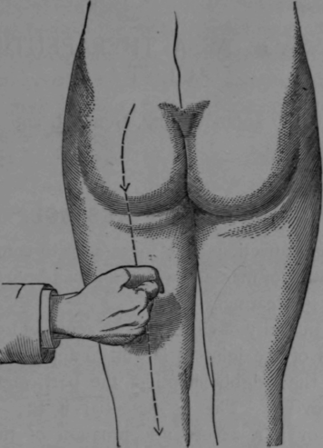 Fig. 14.  Beating over the Sciatic Nerve.