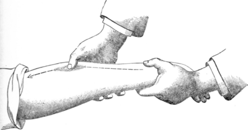 Fig. 3.   Stroking with the Thumb.