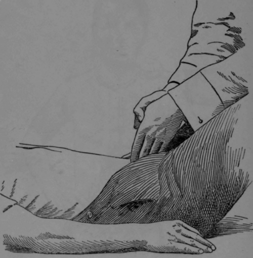 Fig. 30.   Vibration over the bladder.