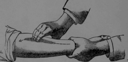 Fig. 4.   Stroking with the Tips of the Fingers.