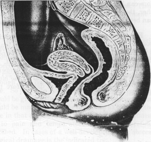 Fig. 1. The Uterus in Normal Position. (Findley, Diseases of Women.)