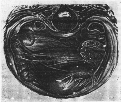 Fig. 10. Pelvic Peritonitis. The uterus is displaced anteriorly and to the left. Adhesions bind it to the bladder and intestine and to the tubes and ovaries * * *. These plastic inflammations are due to gonorrhoeal salpingitis or to metritis or perimetritis from puerperal or operative lesions of the genital mucous membrane. (Schaeffer, Atlas and Epitome of Gynecology.) Left ovary contains multiple cysts.