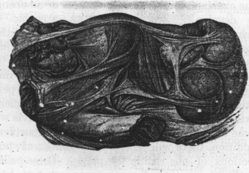 Fig. 11. Pelvic Perintonitis, Perioophoritis, Perisalpingitis and Right sided Pyosalpinx. View of the pouch of Douglas. Pseudoligaments fix the uterus and its adnexa to the sigmoid flexure. The left tube is bent at an angle, the right tube shows inflammatory redness and is transformed into a pyosalpinx by the agglutination of the abdominal ostium. The globular divisions of the tumor are characteristically shown. (Schaeffer, Atlas and Epitome of Gynecology.)