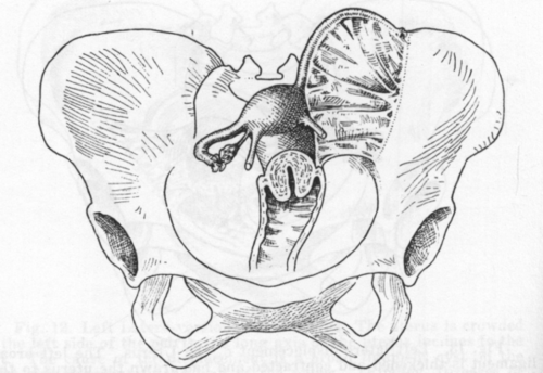 Fig. 14. Contraction of the left broad ligament drawing the uterus into a left lateral position. (Findley, Diseases of Women.)