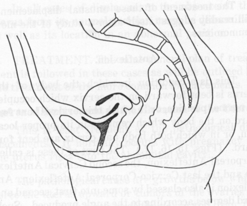 Fig. 15. Corporeal Anteflexion.