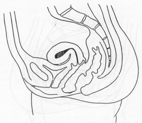 Fig. 17. Cervico corporeal Anteflexion.