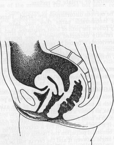 Fig. 20. Fibroid in Anterior Uterine Wall Resembling an Anteflexion.