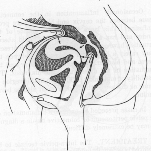 Fig. 21. Replacement of an Anteflexion Caused by Adhesions.