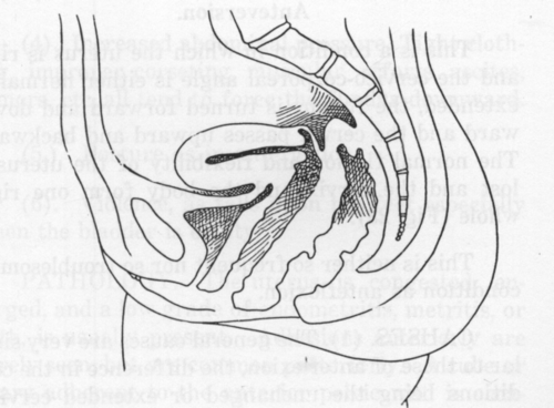 Fig. 23. Anteversion.