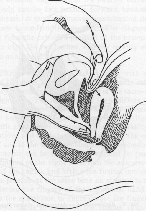 Fig. 24. Replacement of an Anteversion. First Step.