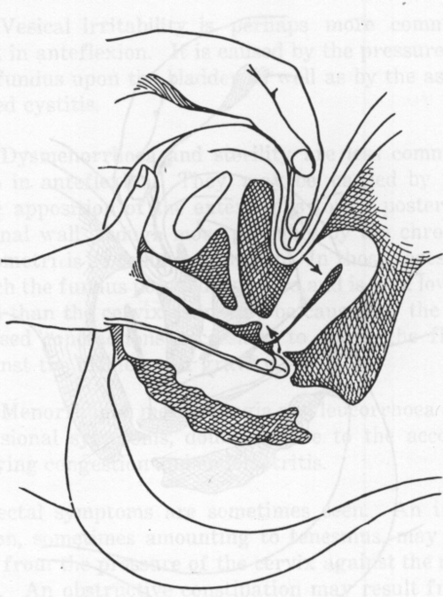 Fig. 25. Replacement of an Anteversion. Second Step.