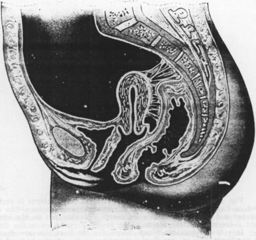 Fig. 28. Retroposition and retroversion of the uterus, with fixation. Peritoneal adhesions bind the posterior surface of the uterus to the sacrum and rectum, holding the uterus firmly in retroversion and retroposition. (Findley, Diseases of Women.)