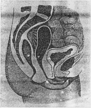 Fig. 29. Retroversion of a Fixed Uterus. The uterus is vertical and is fixed by sacro uterine and recto uterine adhesions—the contracted and shortened uterine ligaments. Vagina put on the stretch by the elevation of the uterus.
