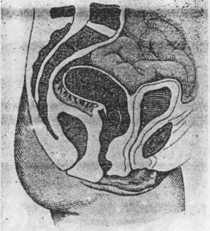 Fig. 30. Retroflexion of a Fixed Uterus—uterus bound down throughout its entire length to serosa of Douglas' pouch by perimetritic adhesions. Cervix forced anteriorly, anterior lip thinned, the anterior cervical wall likewise; posterior lip thickened. Vagina thrown into folds by the descensus. Pressure of the intestines upon the uterus. (Schaeffer, Atlas and Epitome of Gynecology.)